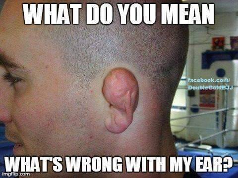 Most Extreme Case of Cauliflower Ears