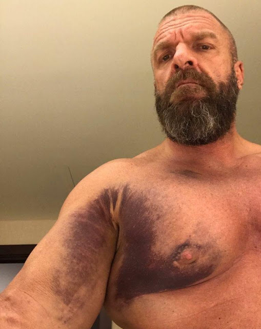 Triple H pectoral muscles tear